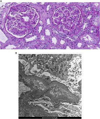 Idiopathic nodular glomerulosclerosis: a case report